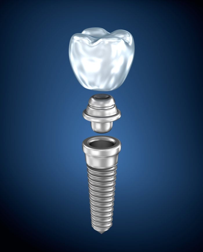 Dental Implants in Quakertown, PA