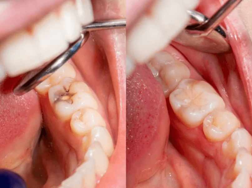 How Cavities Damage Your Teeth