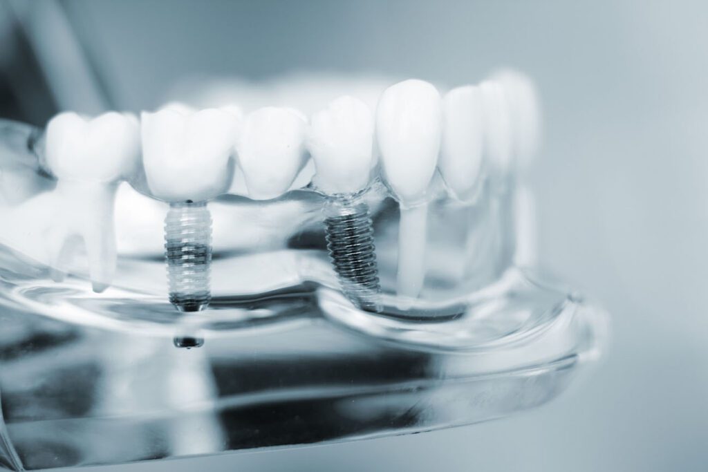 DENTAL IMPLANTS in QUAKERTOWN PA can help restore your bite after losing a tooth
