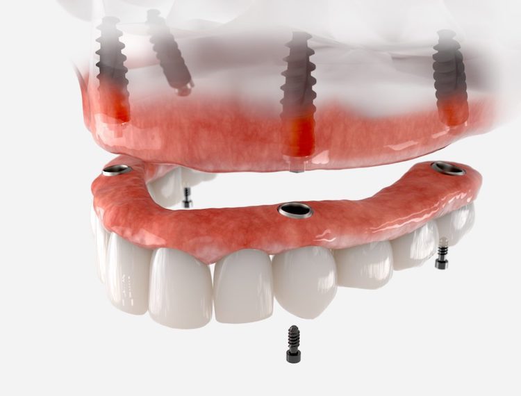 Two primary tooth replacement options exist: traditional and implant dentures. Each offers unique benefits and drawbacks.