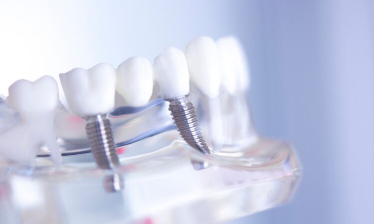 Like any dental work, a dental bridge requires diligent care to ensure longevity and effectiveness for your smile.